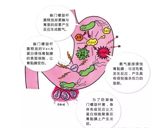 浅谈幽门螺杆菌感染那些事儿