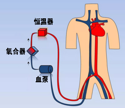 ecmo系统示意图图片