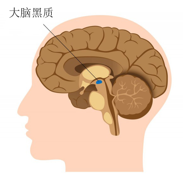 主要的病理改变在大脑黑质的多巴胺神经元的变性死亡,引起脑部多巴胺