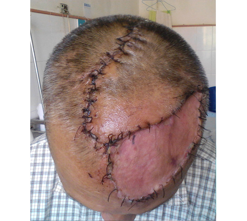 这样的创面如何修复?