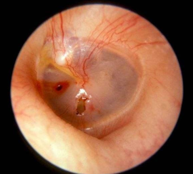 鼓膜多呈不规则状或裂隙状穿孔,外耳道可有血迹或血痂,穿孔边缘可见