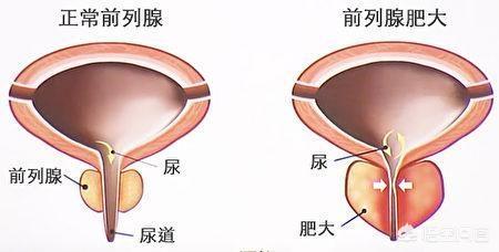 正常情況下成年男性每天可以排泌稀薄乳白色的前列腺液約0.5-2.0ml.