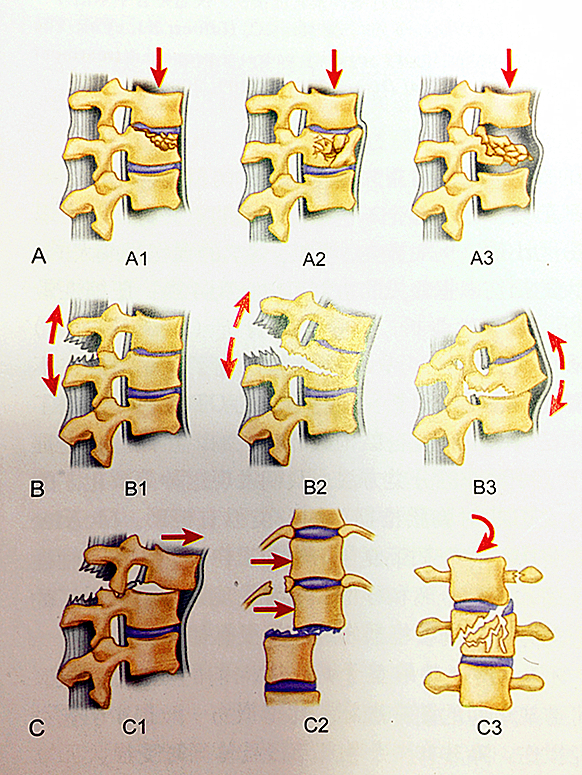 胸腰椎骨折分型图片图片