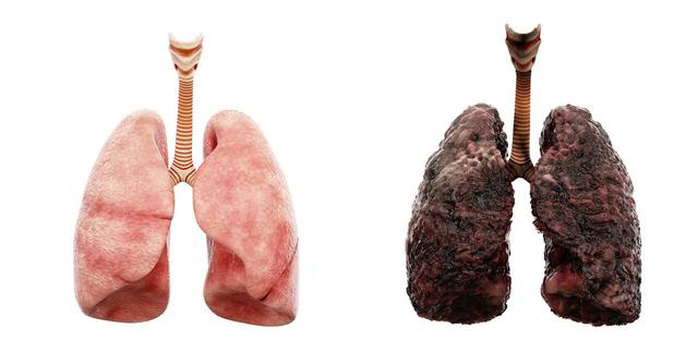 吸烟一个月的肺图片