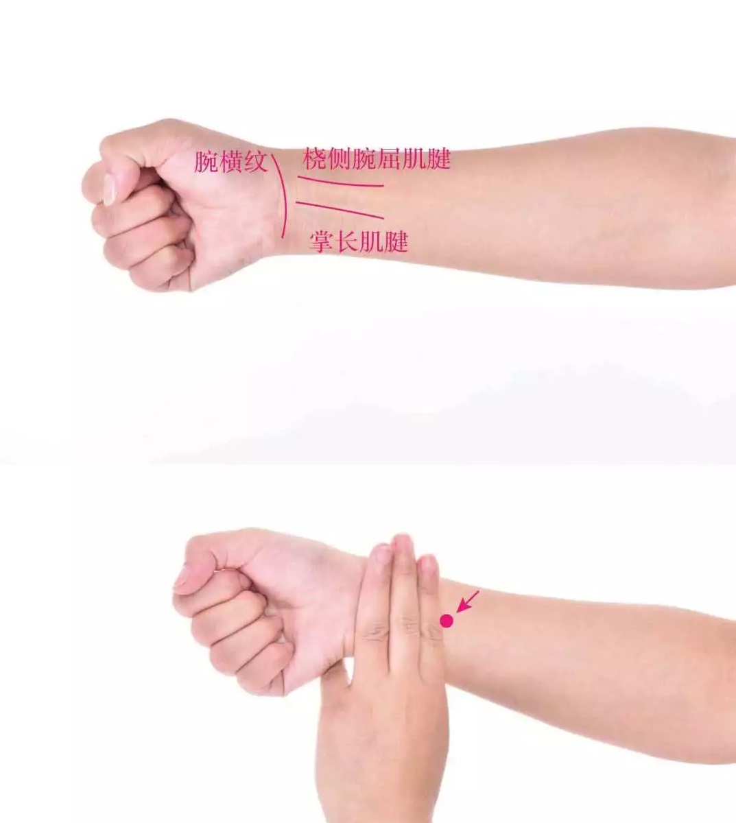 伸臂仰掌,微屈腕握拳,从腕横纹向上3横指,在掌长肌腱与桡侧腕屈肌腱