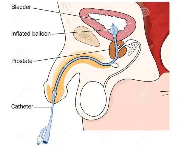 三腔导尿管连接图图片