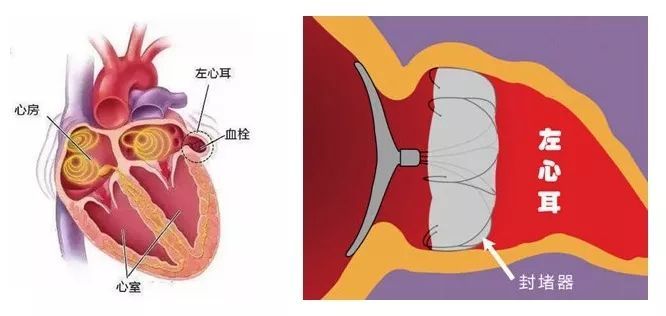 左心耳封堵适应症图片