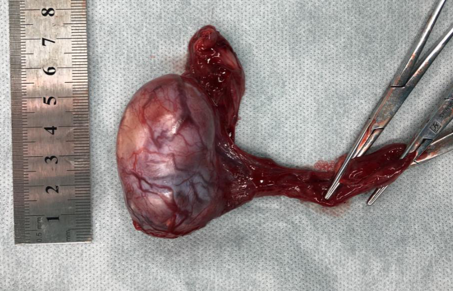 阴囊癌晚期症状图片图片