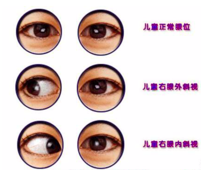 一把手电筒辨别真假斜视-春雨医生