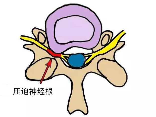 頸椎Ⅳ最常見的頸椎病類型神經根型頸椎病