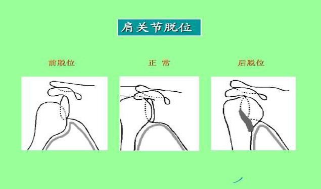 偏瘫患者常见的肩的问题-肩关节半脱位