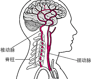 颈椎Ⅴ让人头疼颈椎病椎动脉型颈椎病