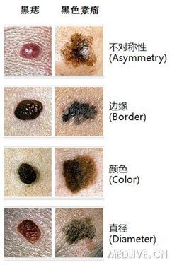 普通痣和spitz痣图片图片