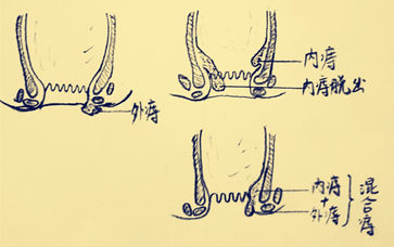 齿状线肛缘图片