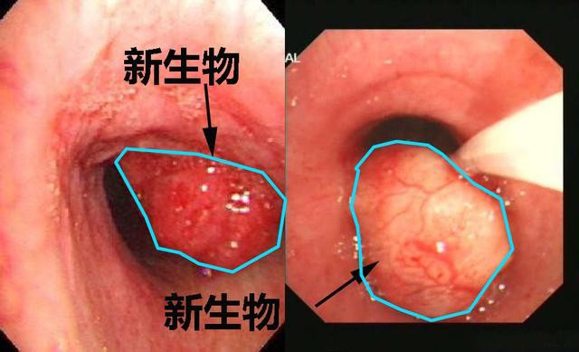 声带白色新生物照片图片