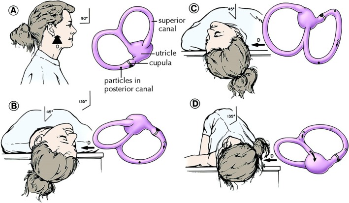 耳石症复位手法 步骤图片