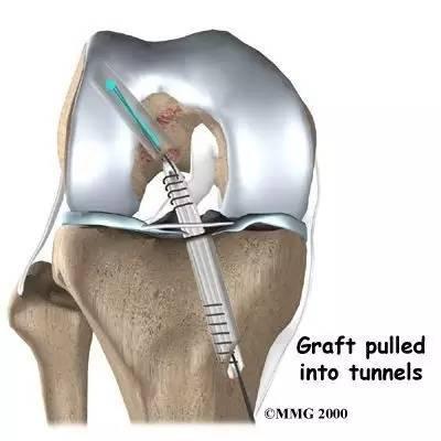 术后康复交叉韧带重建术后立即开始康复,康复治疗人员必须小心保护acl