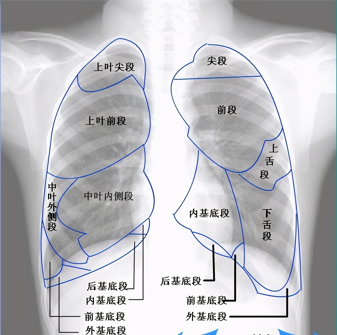 肺炎x光片图解图片