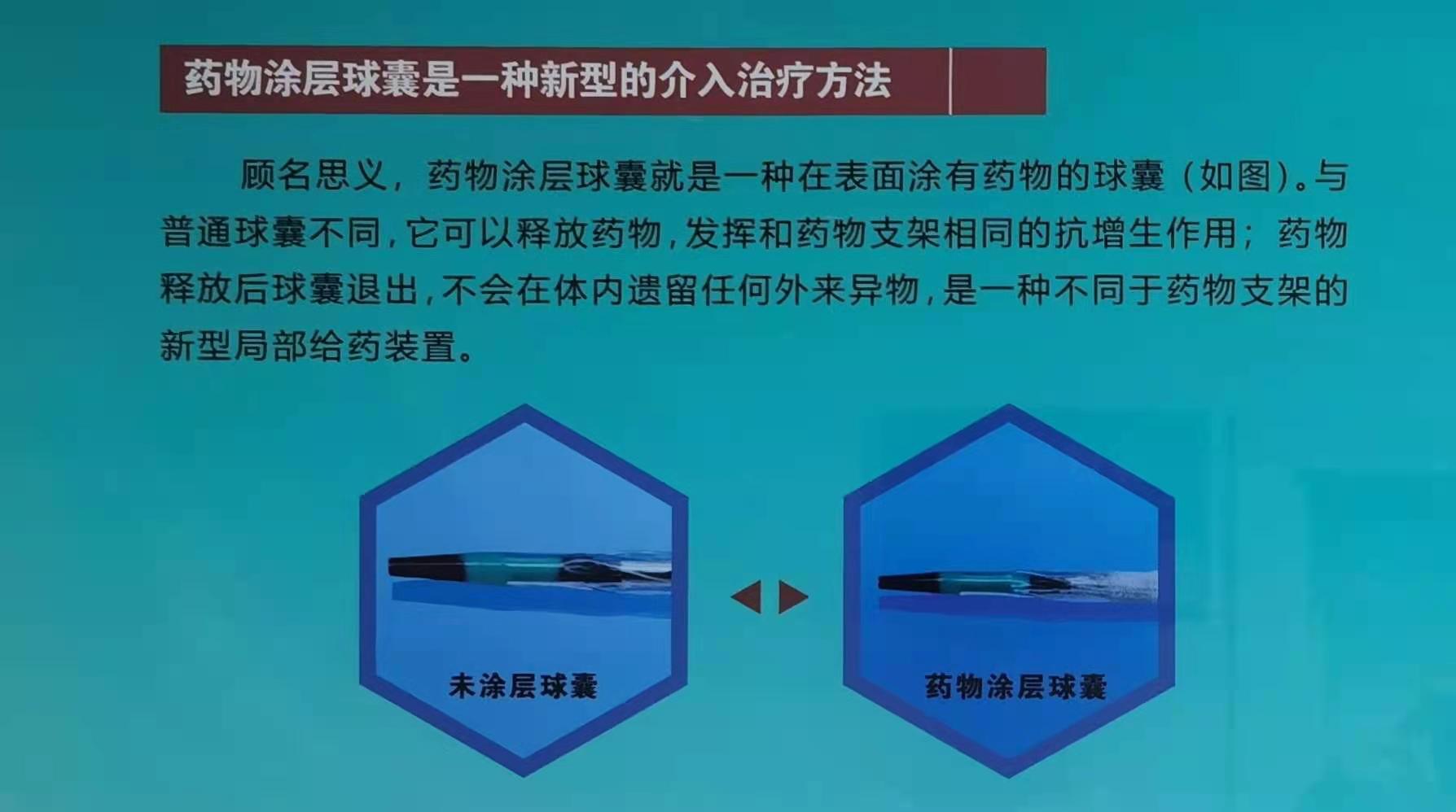 药物涂层球囊一种介入无植入的冠脉狭窄解决方案
