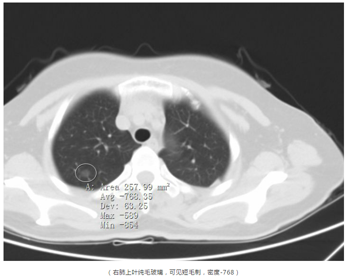 早期肺癌之原位癌ais