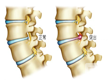 腰椎间盘突出和腰椎间盘突出症一样吗?