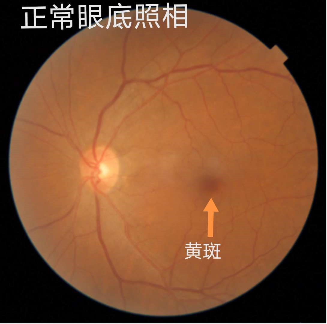 正常黄斑位置形态及黄斑oct检查如下展示:在门诊上,经常会遇到一些