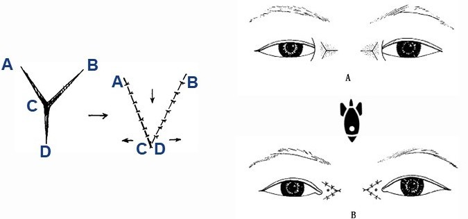 眼整形科普五:内眦赘皮术式解读——y-v成形术-春雨医生