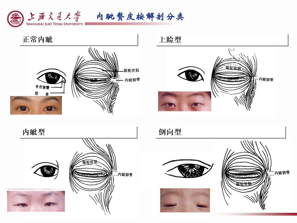 内眼角结构图图片