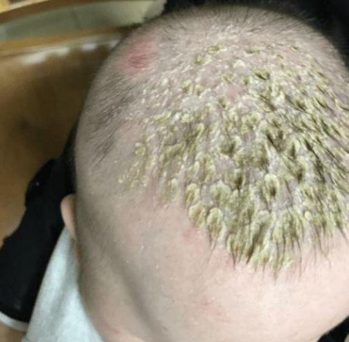 膎窝,为成群小丘疹,较干燥并可融合成片,局部皮肤由增厚或呈苔藓样变