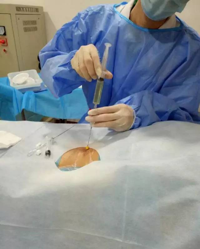 "我怎么没听说过巧克力囊肿还可以这样治?
