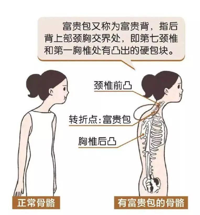 论颈椎病富贵包之自我康复真包假富贵