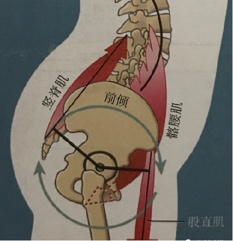 臀大肌薄弱,屈髋肌紧张,骨盆前倾,腰椎前凸角度增加,腰椎后方间隙变窄