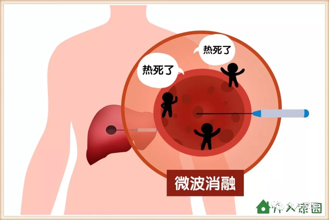 治疗肿瘤的七大靶向精准微创介入治疗方法(肝癌,肺癌,胰腺癌,肝血管瘤