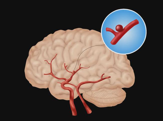 脑动脉瘤好的治疗方法