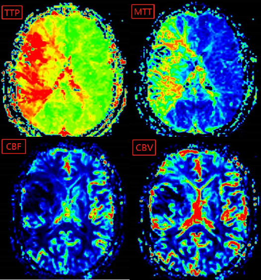 輔助檢查:核磁灌注圖:dwi示右側額顳枕島葉,半卵圓中心,放射冠區及
