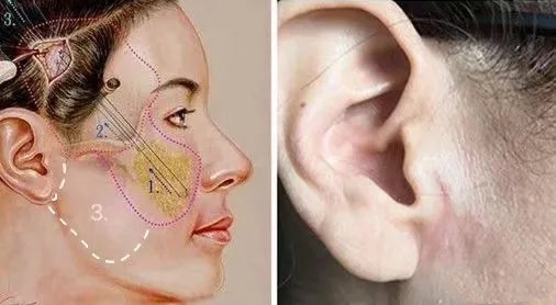 抗衰提升提到的smas筋膜层有何意义?