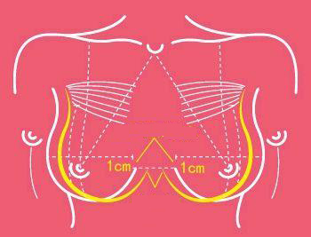 自体脂肪丰胸卧立位画线方式的区别