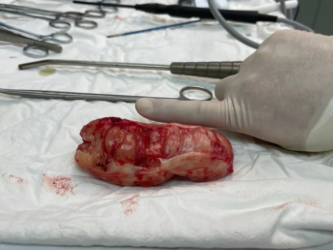 一例食管平滑肌瘤手术分享