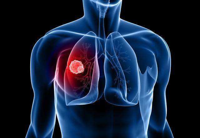 肺癌9.jpg