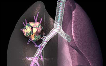 肺癌12.jpg