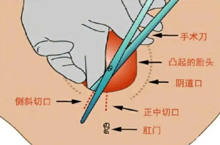 子宫侧切图片图片