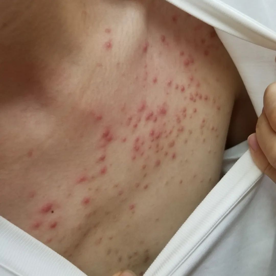 来夏季常见皮肤病马拉色菌性毛囊炎