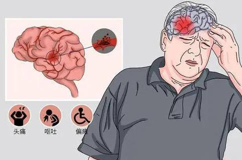 脑溢血是怎么引起的图片