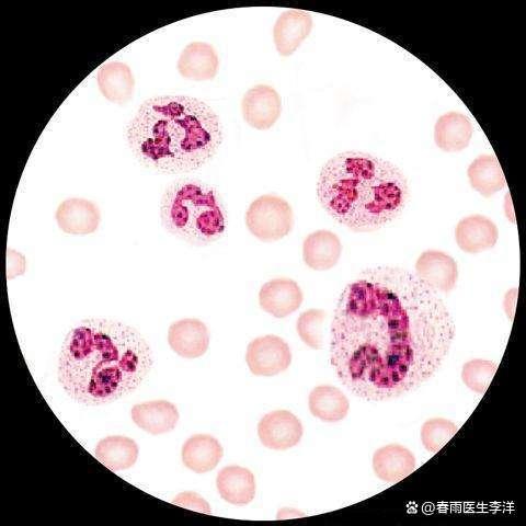 谈谈儿童中性粒细胞减少那些事