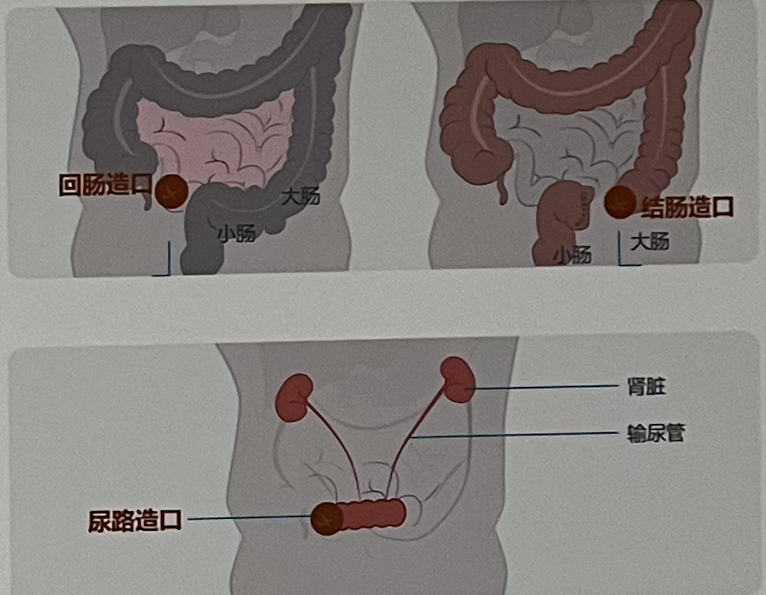 双腔回肠造瘘结构图图片