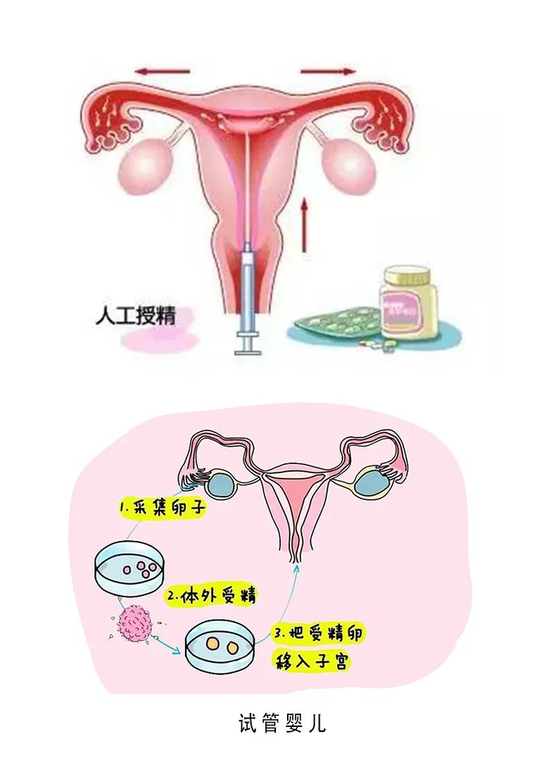 一图一表看懂人工授精和试管婴儿