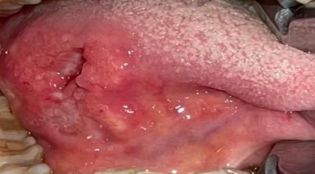 【口腔】口腔颌面部癌症分期表现图解