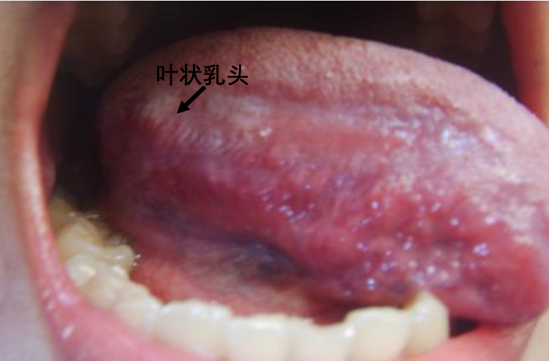 ④轮廓乳头舌下伞襞:足不出户,让上海九院医生为您服务