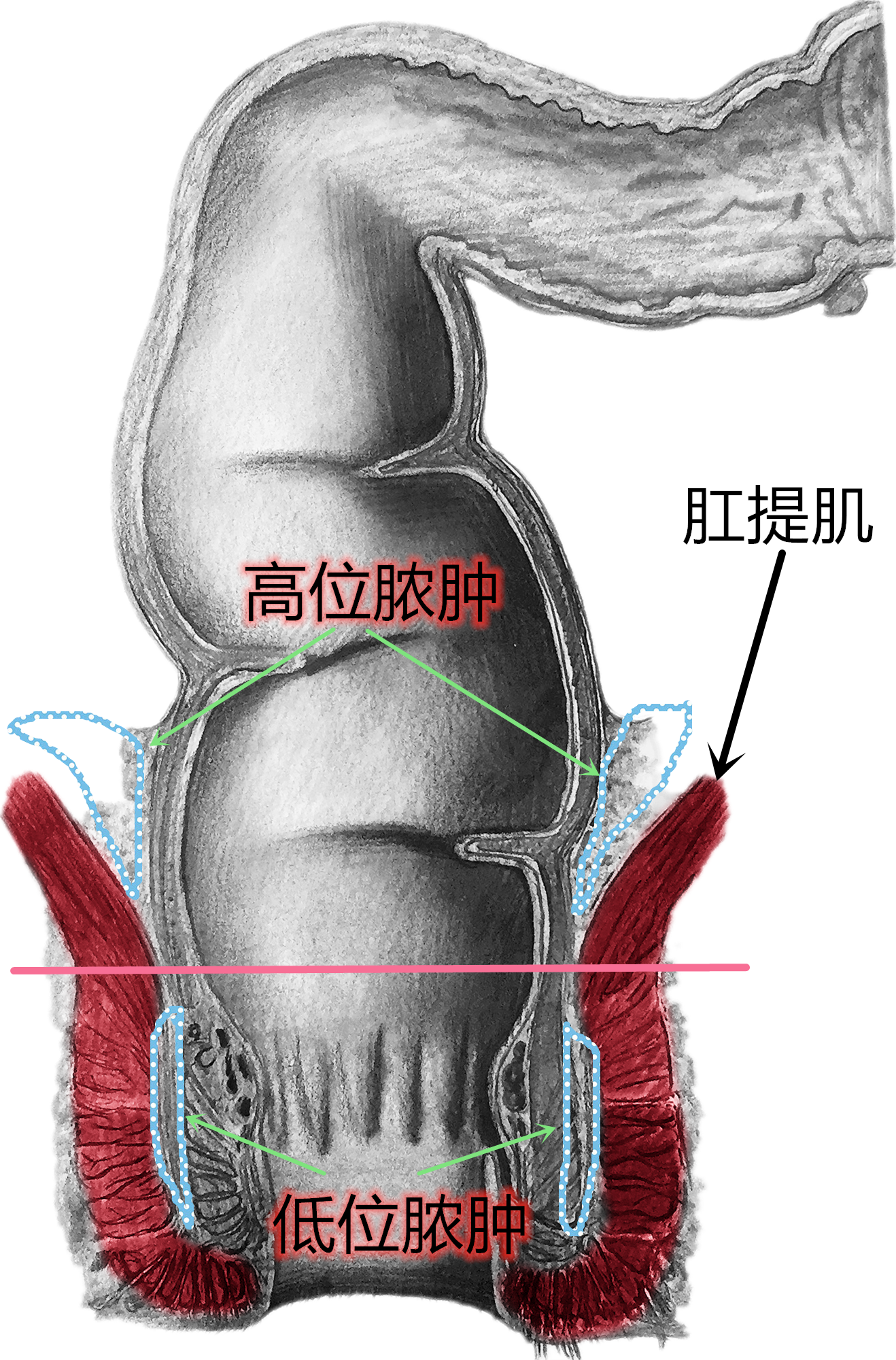 肛周脓肿手术示意图图片