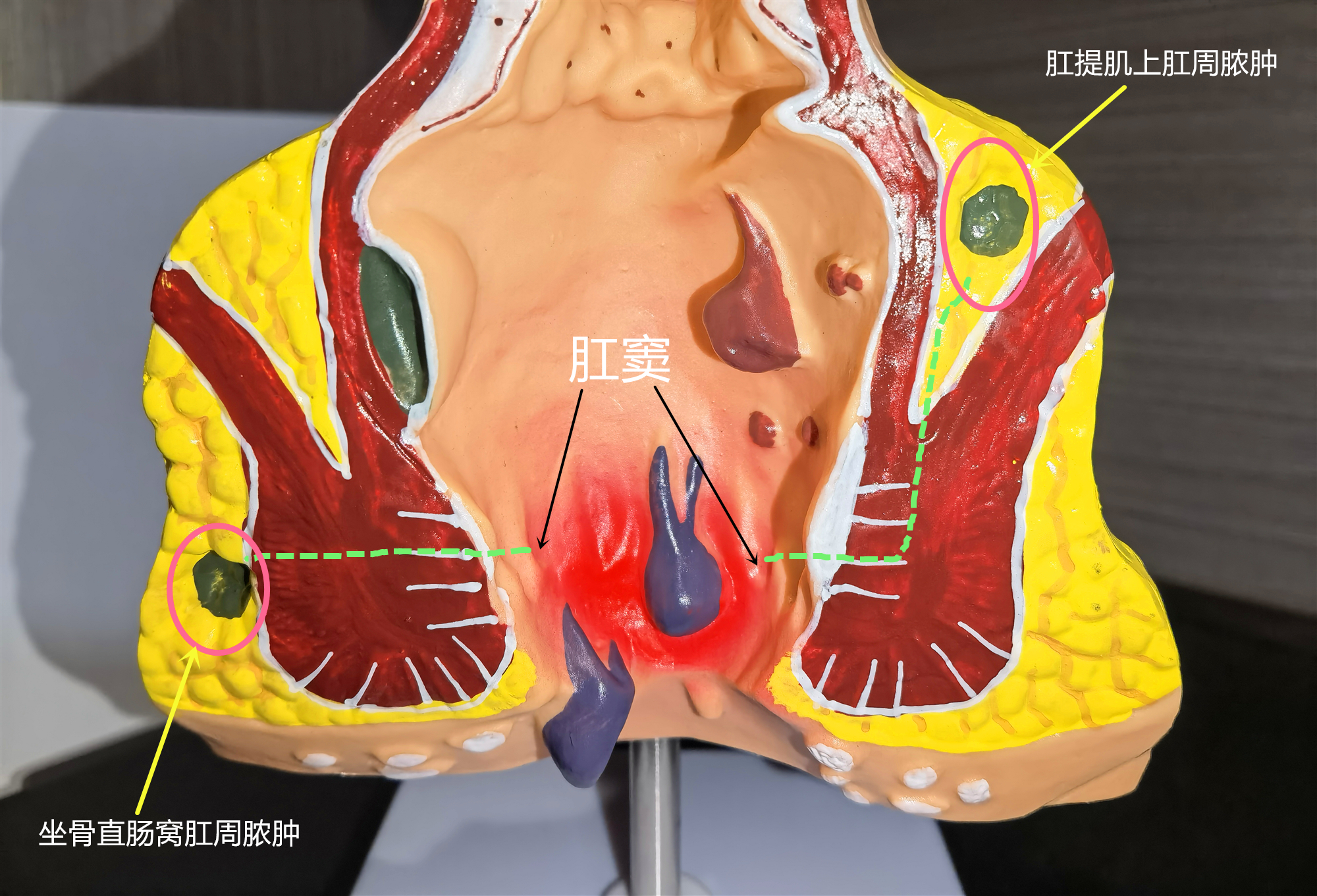 肛管直肠周围脓肿图片